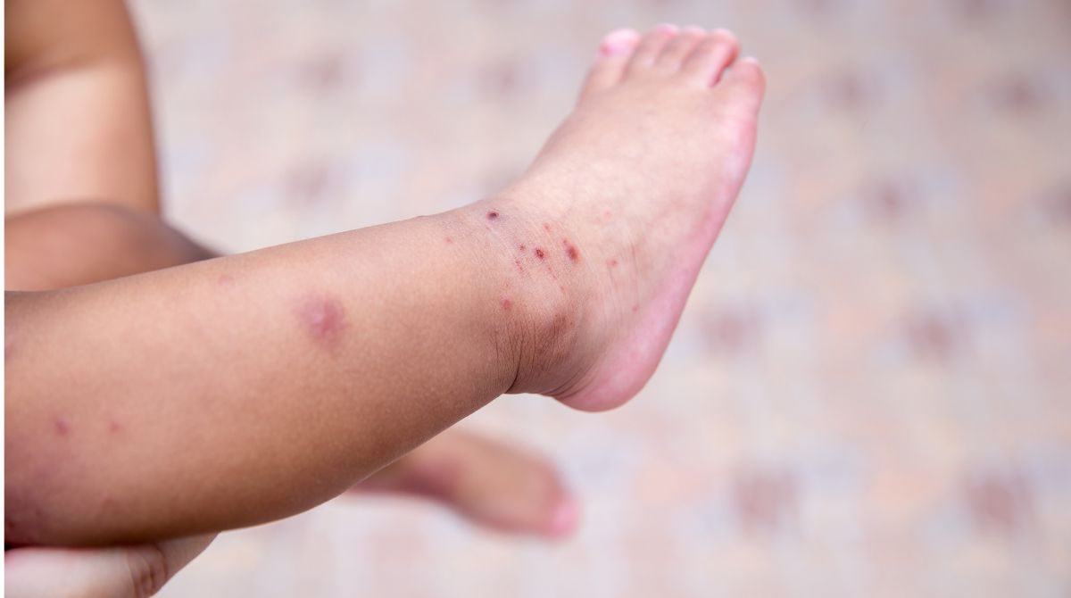 hand foot mouth disease pada anak, flu singapura