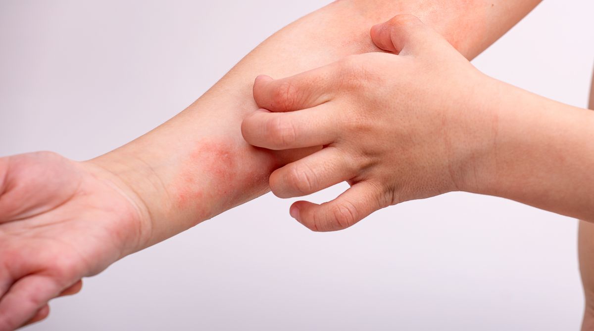 dampak dermatitis atopik pada anak, dermatitis atopik