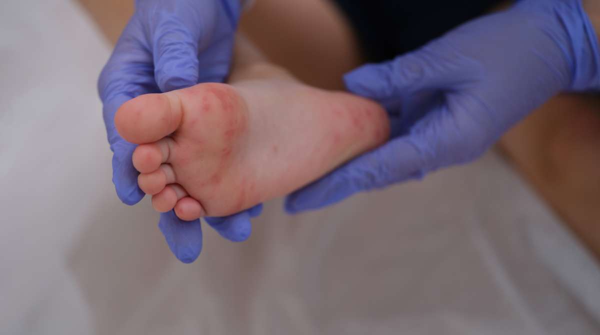 penyakit kawasaki pada anak